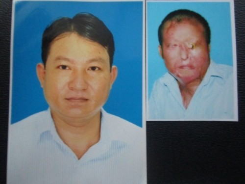 .. anh Tuấn, ba nạn nhân trong vụ tạt axít kinh hoàng